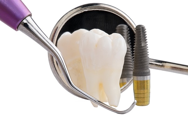 teeth-implants-cost