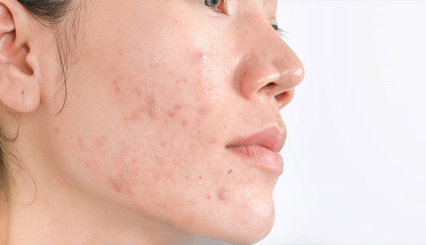 acne-on-womans-face