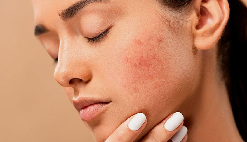 woman-with-acne